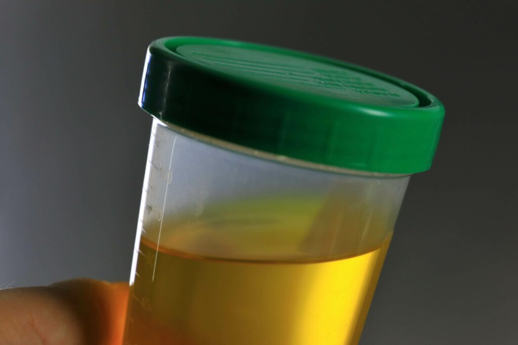 Shown here: A urine sample is collected in a specimen bottle.